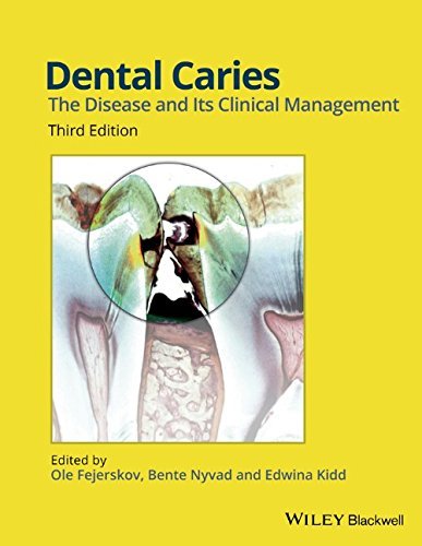 Dental Caries: The Disease and its Clinical Management by Ole Fejerskov (Editor), Bente Nyvad (Editor), Edwina Kidd (Editor) (8-May-2015) Hardcover
