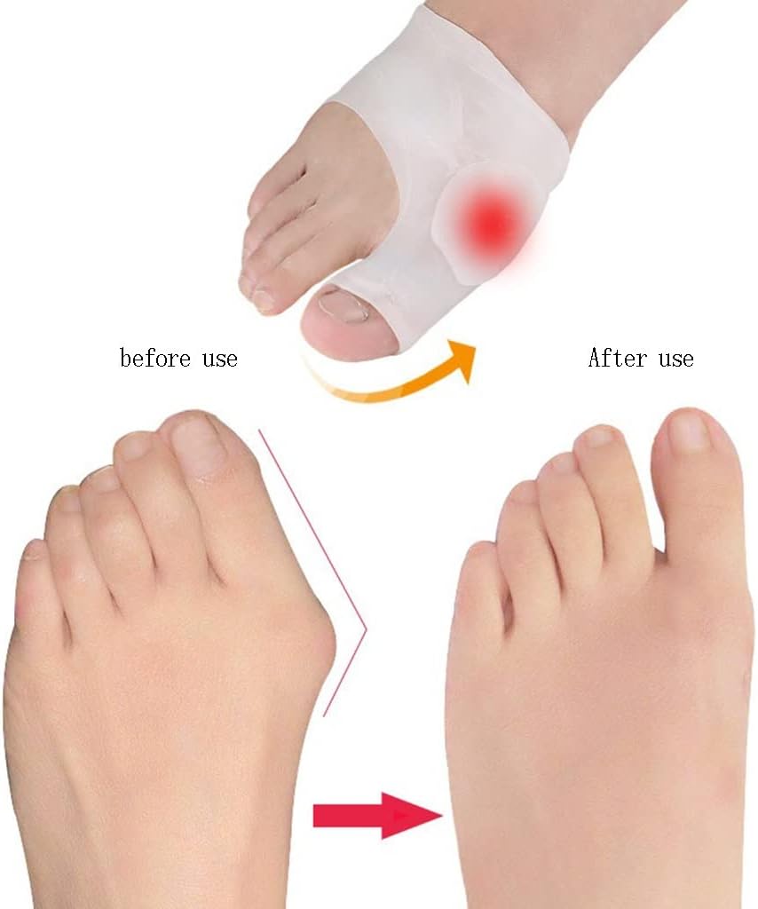 DEAVER Big Toe Overlap Correction, Hallux Valgus Splitter, Insoles Silica Gel Pad Protectors,Toe Caps Blister Protectors, Metatarsal for Forefoot Cushion