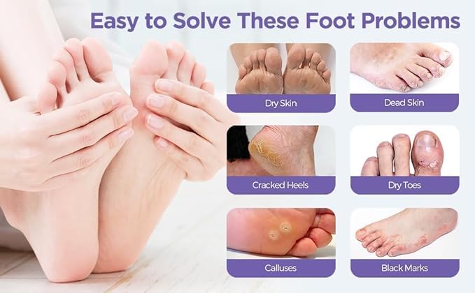 ERITIN Foot Peel Mask for Women & Men | Peeling & Exfoliating Foot Mask for Dry Cracked Feet, Removes Dead Skin & Calluses, Hydrates & Smooths Cracked Heels (Pack of 1) (GOAT MILK) 2