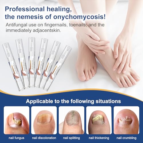Image of Toenail Fungi Treatment Extra Strength - Fungi Nail Pen, 25% Undecylenic Acid, Ingrown toenail treatment, Fungus nail treatment, yellow toenail, Damaged Nails foot fungus treatment extra strength
