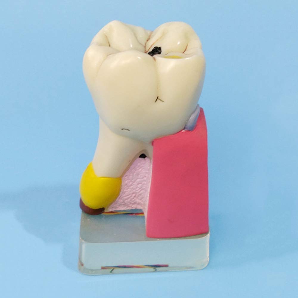 Model Zębów, Model Patologii Stomatologicznej, Analiza Implantów, Demonstracja Crownbridge, Choroba Przyzębia, Różne Zęby, Dziąsła, Narzędzia Do Pielęgnacji Zęb