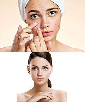 Amazon.com: Sebionex Trio Anti-imperfection Corrective Face Cream