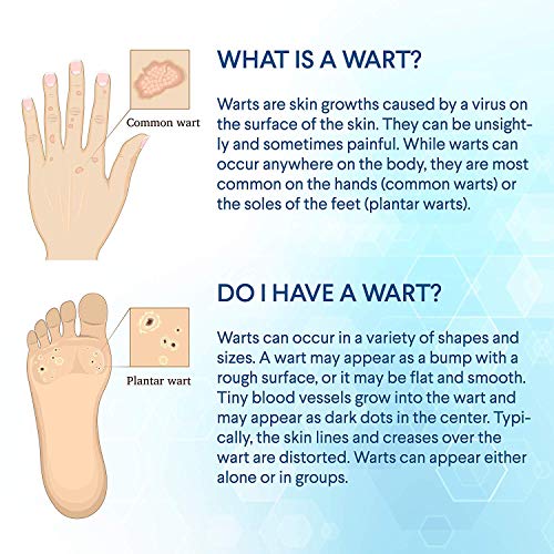 Wart Removal, Corn Removal, Painless Removal of Plantar, Common Warts and Infections, Promotes The Healing of Calluses and Corns(10ml)