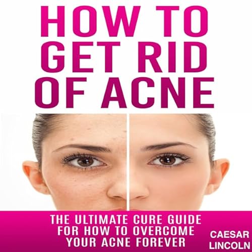How to Get Rid of Acne Audiolivro Por Caesar Lincoln capa
