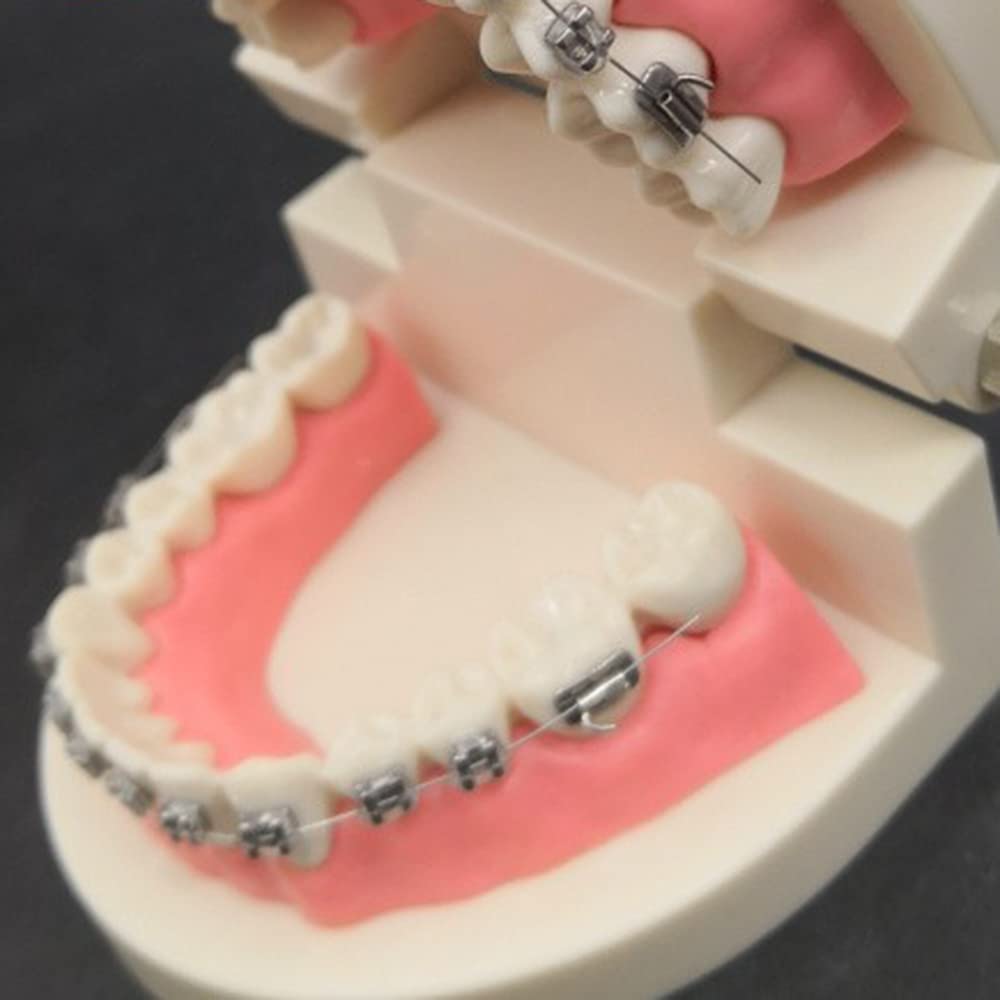 Modello di Simulazione dei Denti orali - Modello dimostrativo ortodontico Dentale - Modello di Trattamento dei Denti dentali con Attacco Metallico, Modello esplicativo dell'ar,B