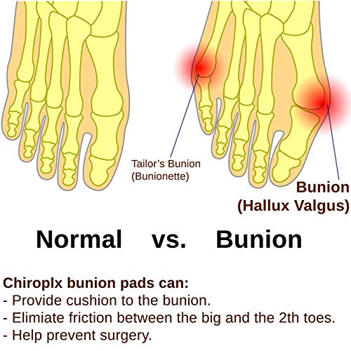 Chiroplax Bunion Corrector Relief Cushion Pads Guard Toe Separator Straightener Splint Protector Shield Spacer Sleeve Cover Hallux Valgus (4 Pads W/Shims, Size Regular) #TOP4