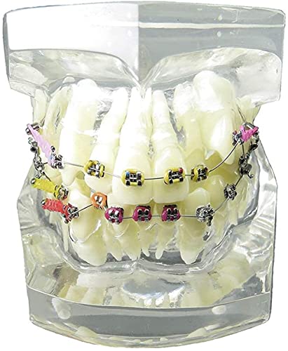 Modèle dentaire malocclusion pour expliquer le traitement aux patients