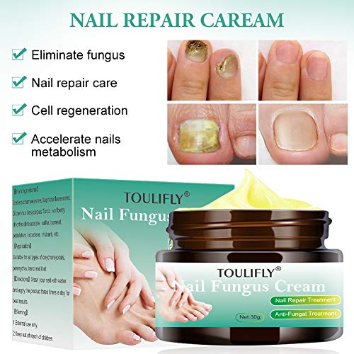 Nail Fungus Cream,Toenail Fungus Treatment,Nail Fungus Remover,Toenail Fingernail Fungus Remover Fungus Stop Cream
