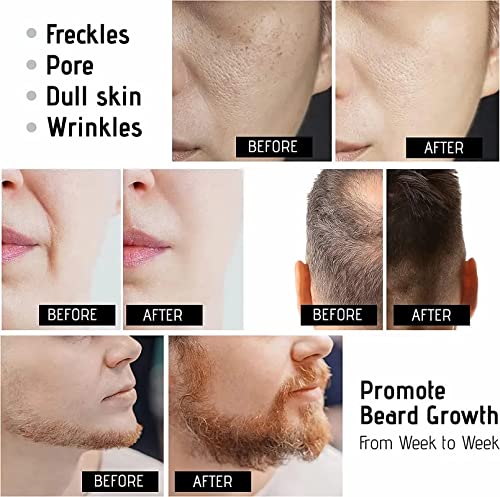 image for RYUUSEI Derma Roller Microneedle Roller for Face, Beard Roller, Micron