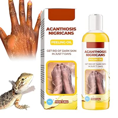 Acanthosis Nigricans Peeling&ouml;l, Peeling&ouml;l f&uuml;r dunklen Fleck, gelbes Peeling&ouml;l f&uuml;r dunkle Haut 1 St&uuml;ck