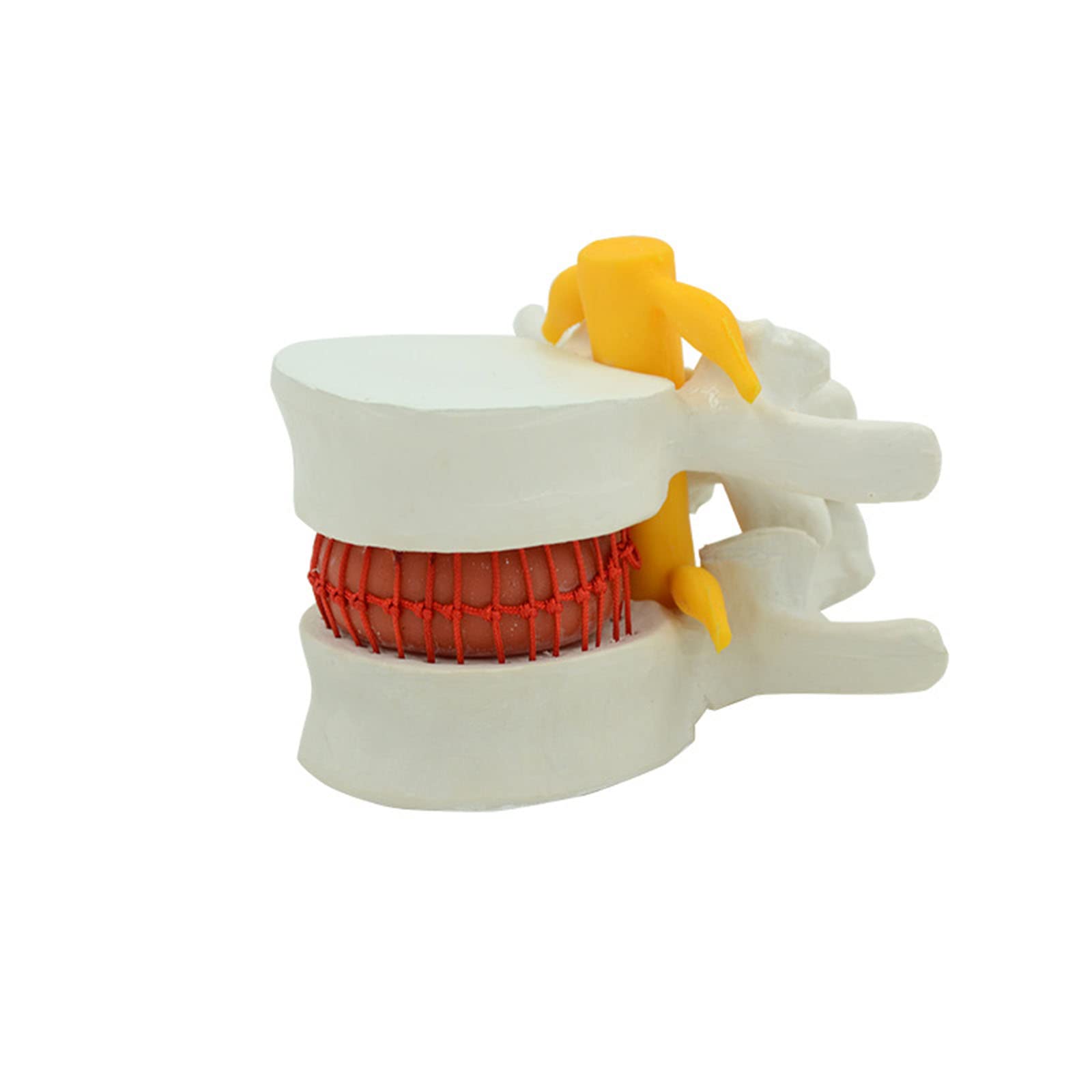 GTHTUHFD Human Lumbar Disc Herniation Model Human Lumbar Disc Herniation Demonstration Model Plastic Human Lumbar Disc Herniation Model .99 .99,White