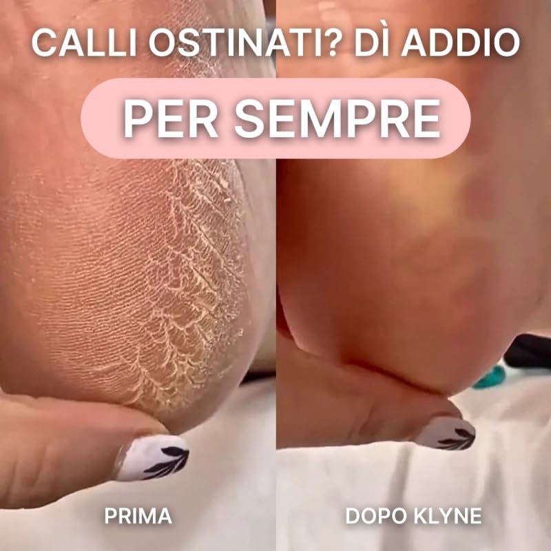 KLYNE Beauty Lima Elettrica Piedi Professionale con 60 Dischetti Sostituibili, Rotazione 360°, Attrezzi per Cura dei Piedi