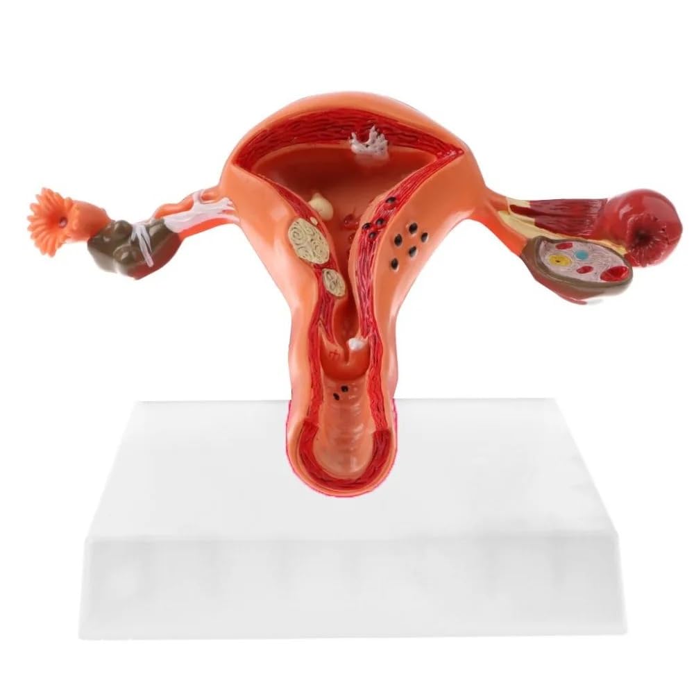 Bcomfy Women's One Color Human Pathological Uterus Ovary Model Cross Section Structure Model Uterus Anatomical Model Anatomy Organ Study Tool