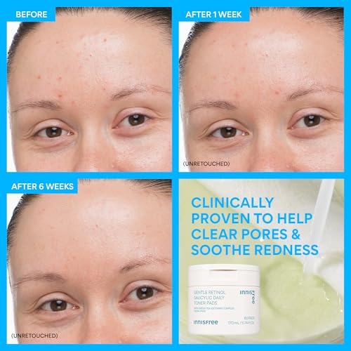 innisfree Daily Gentle Retinol Salicylic Toner Pads, Korean Sheet Mask Pads for Acne-Prone Skin Care