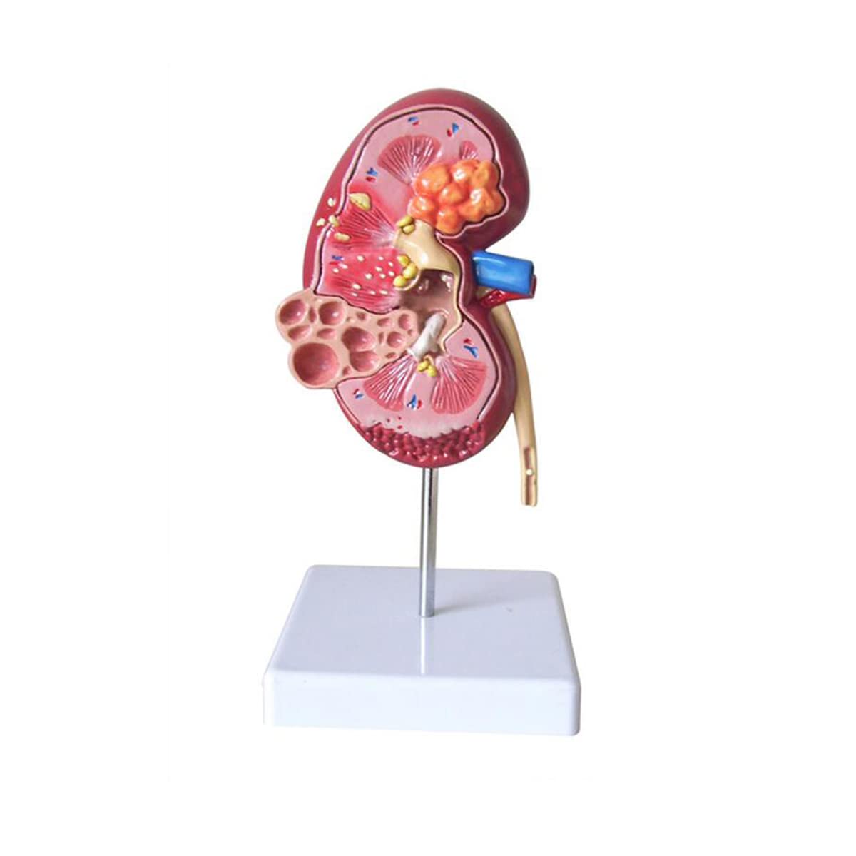 Pathologisches Modell, menschliches Nierenläsionsmodell, Anatomie, pathologisches Steinorgan, Nierensteine, Urologie, Nierenmodell für medizinische Lehr-/Bildungsbedarf