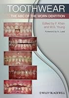 Algopix Similar Product 20 - Toothwear: The ABC of the Worn Dentition