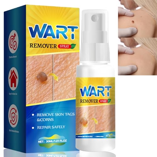 30ml Verucca Freeze Treatment,Verruca and Wart Remover,Wart Freeze Spray,W/Art Remover for Hands,Wart Remover Freeze Treatment,Wart and Skin Tag Remover,Mole Remover,Tag Removal Removes Skin Tags