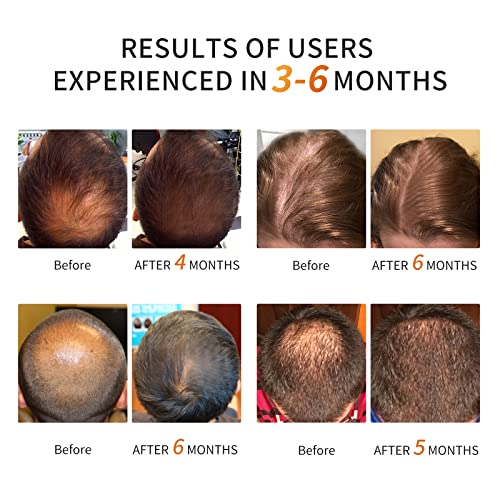 Cosbeauty Professional Hair Growth Laser Cap - Fda Cleared Low Level Laser Therapy Hair Regrowth For Men & Women, Hair Loss Treatment For Androgenetic Alopecia #TOP2