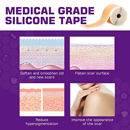 Silicone Scar Sheets Soft Silicone Gel Scar Tape Painless Silicone Tape For Softening And Flattening - Reusable, Medical Grade Silicone Scar Strips For C-Section & Keloid Surgery, Burn, Acne(1.6'' X 60'’) #TOP1