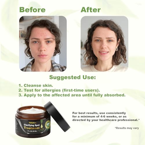 Image of Cystic Acne Spot Treatment - Tea Tree Acne Cream - Fast-Acting Acne Spot Corrector for Face, Pimples & Blemishes - Non-Greasy, Gentle Formula - 1oz - by WELLUTION