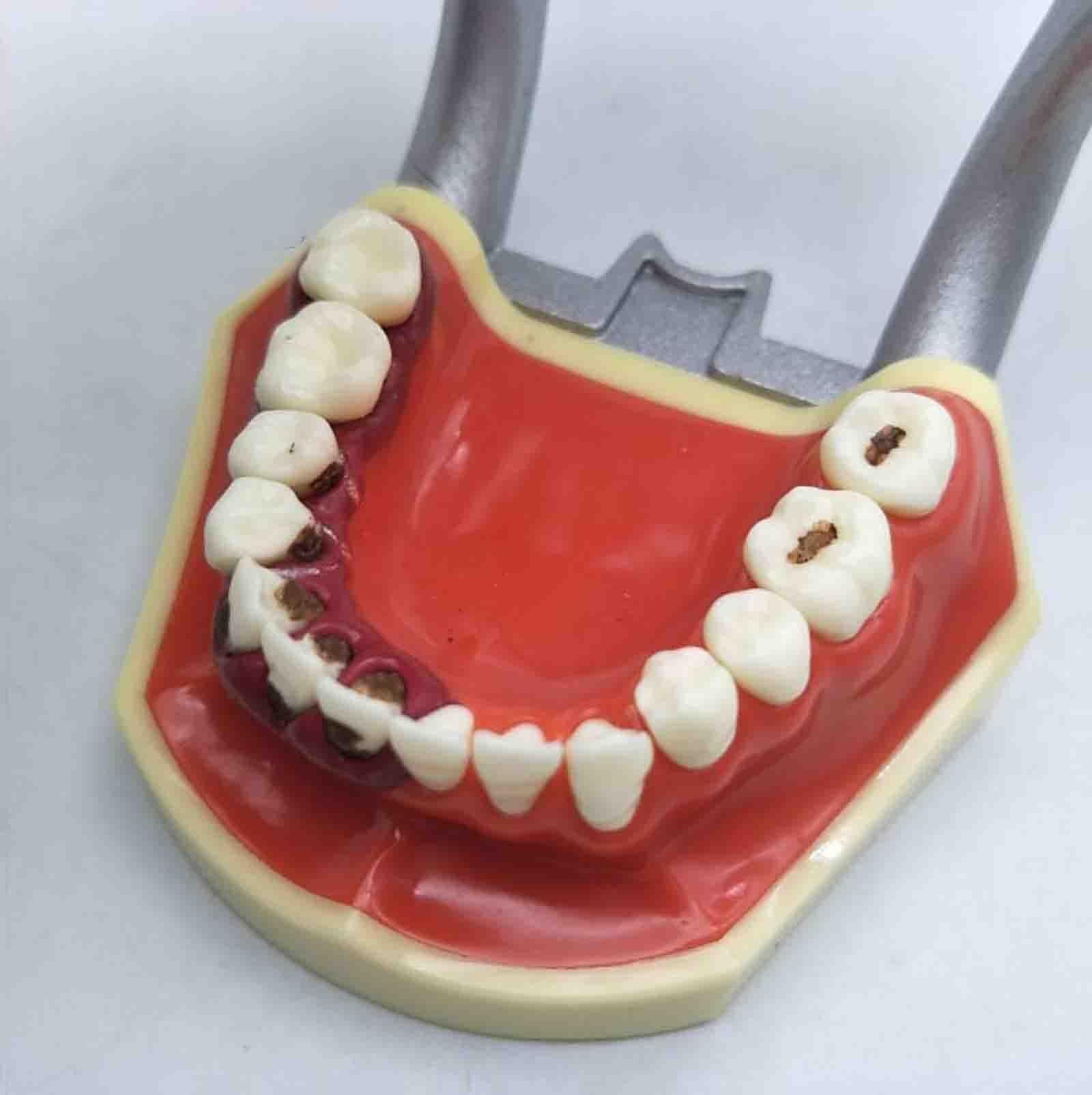 Model patologii przyzębia – kamień nazębny | Model dentystyczny typu typodont – zęby wkręcane – metalowy uchwyt