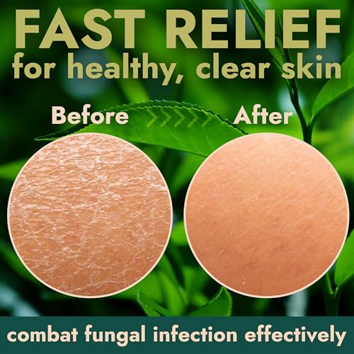 Image of Antifungal Soap with Tea Tree & Eucalyptus, Deep-Cleansing Pumice Bar Soap | Deep Cleansing & Exfoliating Bar, Natural Ingredients, Helps Soothe Jock Itch, Ringworm & Athlete's Foot, Pumice Bar Soap