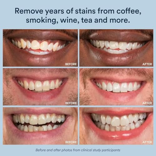 Image of Auraglow Teeth Whitening Pen - Extra Strength 9% Hydrogen Peroxide, 40+ Treatments, No Sensitivity, Removes Coffee Wine Tea Stains, Whiten Teeth Fast, Enamel Safe, Made in USA, 4mL