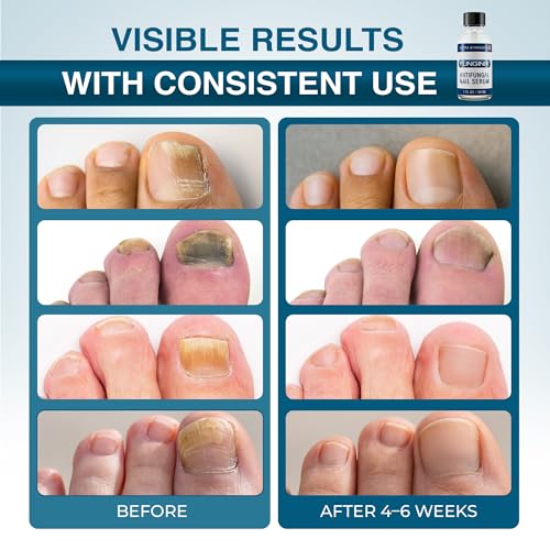 FUNGINIX Fungus Treatment - Toe Fungus, Finger Fungus, and Foot Fungus Solution Made In the USA - Extra...