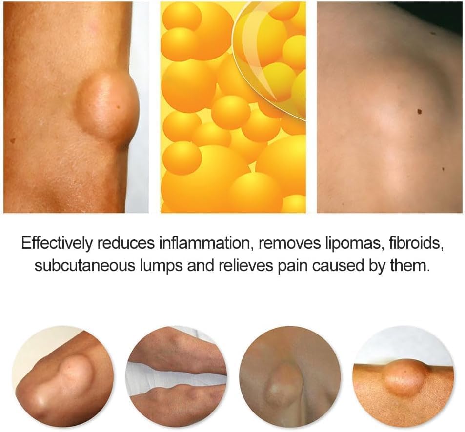 Mazinreem Lipoma Treatment Cream, Herbal Lipoma Removal Cream with Natural Extracts for Soothing and Eliminating Lumps – 20g Ointment for Lipoma Care