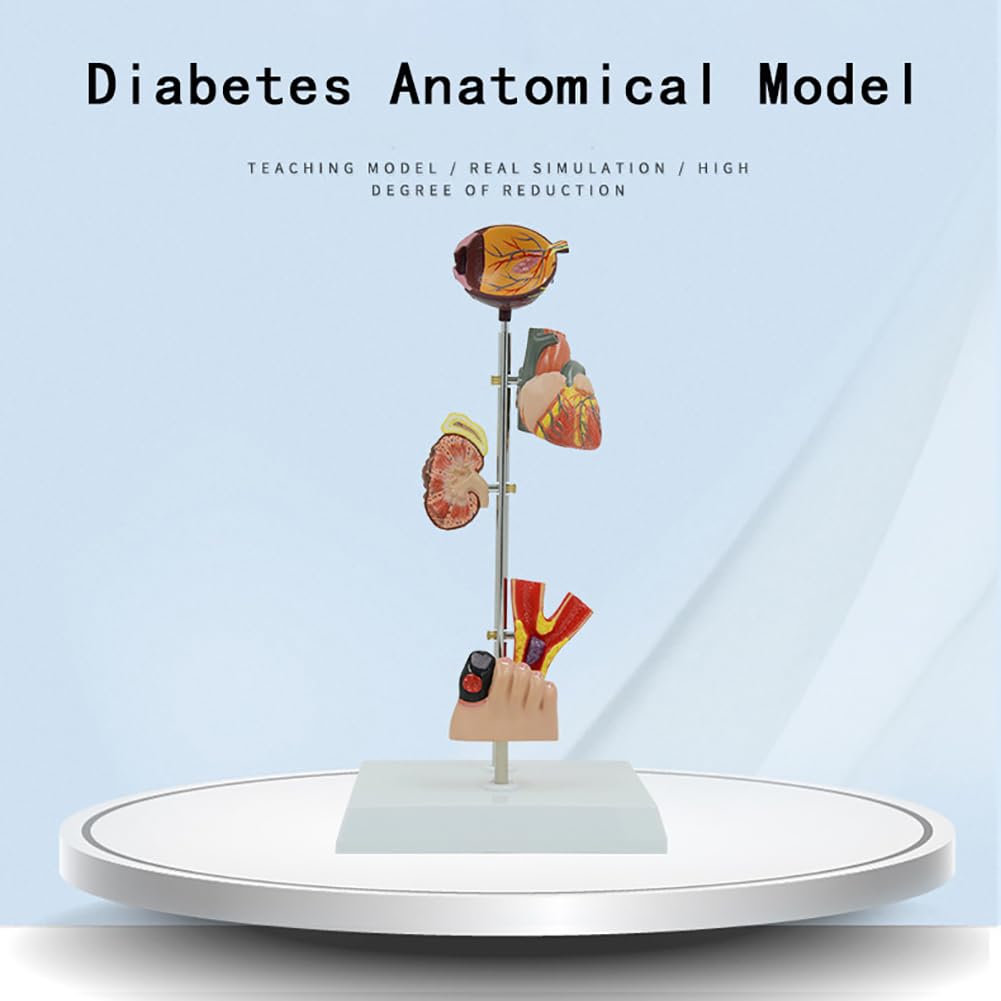 Modèle De Diabète Médical, Modèle D'organe du Diabète, Modèle Anatomique D'organe Diabétique Pathologique, Modèle D'organe 5 Parties pour Les Médecins