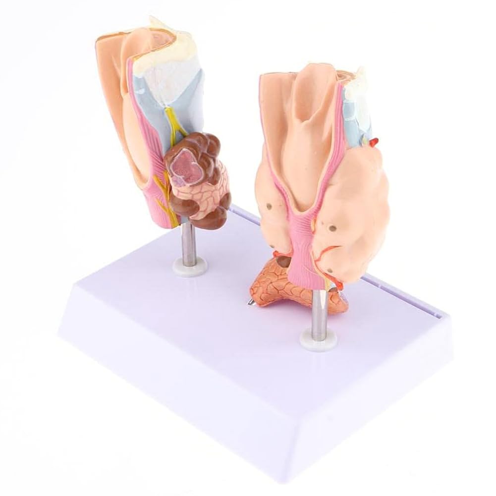 Mavdecll Thyroid Pathology Model, Thyroid Throat Tumor Cyst Model, Human Thyroid Normal & Pathological Anatomy Model, Endocrine Disease Teaching, for Medical Teaching
