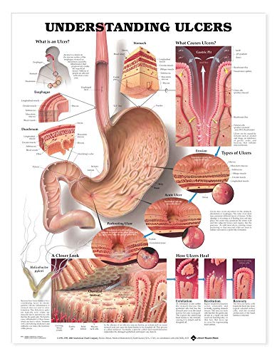 Graphique anatomique des ulcères : poster médical estomac et système digestif