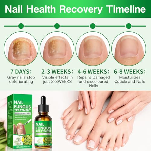 Extra Strong Fungal Nail Treatment, Nail Fungus Treatment For Toenail With Tea Tree Oil, Toe Nail & Ingrown Toenail Treatment, Nail Growth Treatment, Improves Thick Discolored Nails, 5 Patches+30Ml - 6