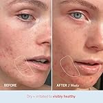 First Aid Beauty - Ultra Repair Cream, Intense Hydration Whipped Colloidal Oatmeal, Clinically Proven to Strengthen Skin Barrier in 7 Days & Helps Relieve Eczema, Luxury Face & Body Moisturizer, 8 oz - Image 5