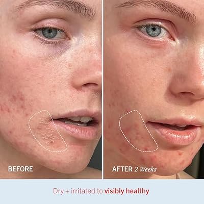 First Aid Beauty Ultra Repair Cream Intense Hydration Moisturiser for Face and Body Rich Whipped Texture For Immediate Skin Hydration, 170.1g