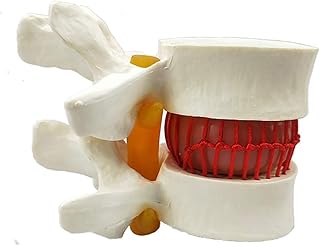 Modelo de demostración de hernia de disco lumbar humano Modelo anatómico de columna vertebral humana Columna vertebral humana amarilla Modelo anatómico de columna lumbar Columna vertebral Hernia de di