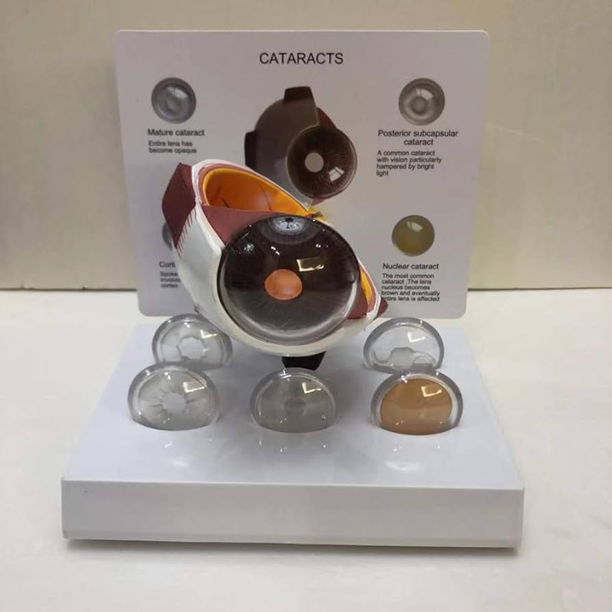 Amazon.co.jp: ModèleAnatomies病気の人間の眼球の祝福の目の角膜