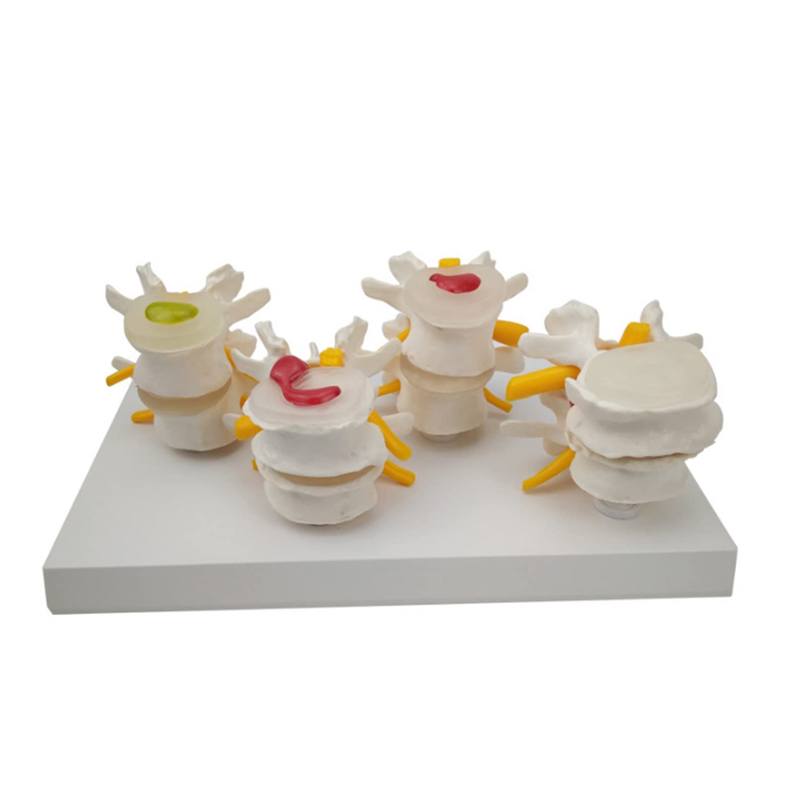 Buy Anatomy Skeleton Spine 4 Stages Lumbar Vertebral Model Human Lumbar