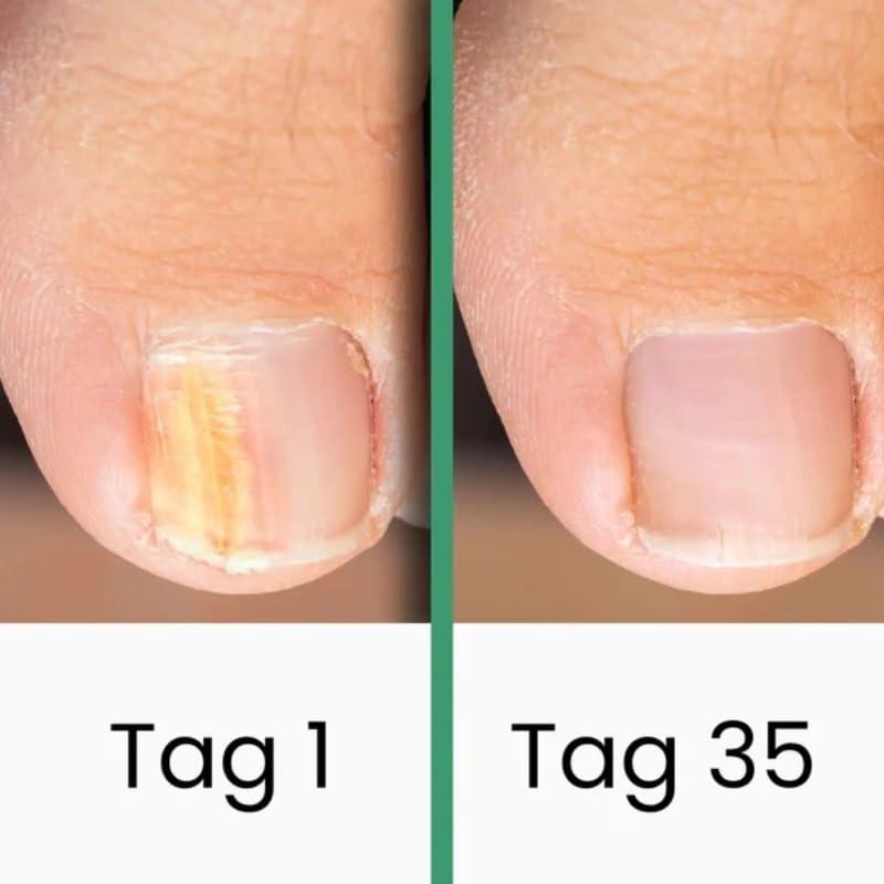 Podomax PODOclip® | LLLT-Nagelpilztherapie(1 Stück)