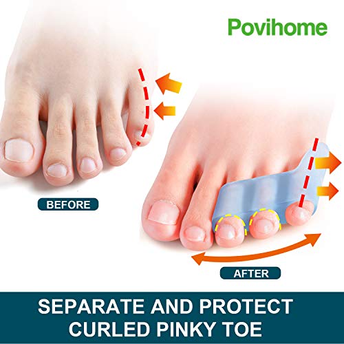 povihome 10 pack pinky toe separator and protectors for overlapping toe curled pinky toes - spacers for morton39s neuroma pain relief