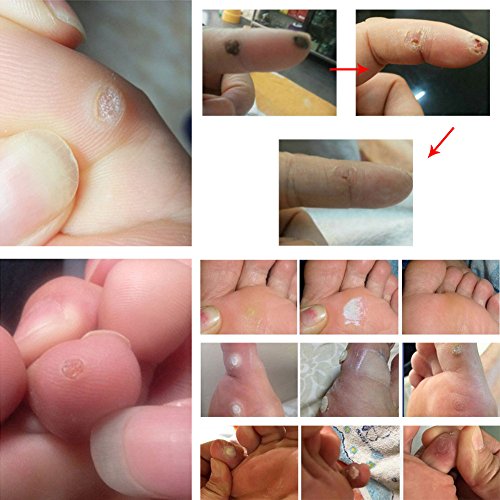 Corn Remover, Corn Removal, Corn Remover Liquid, Foot Corn Removal, Corn Callus Remover, 15ml