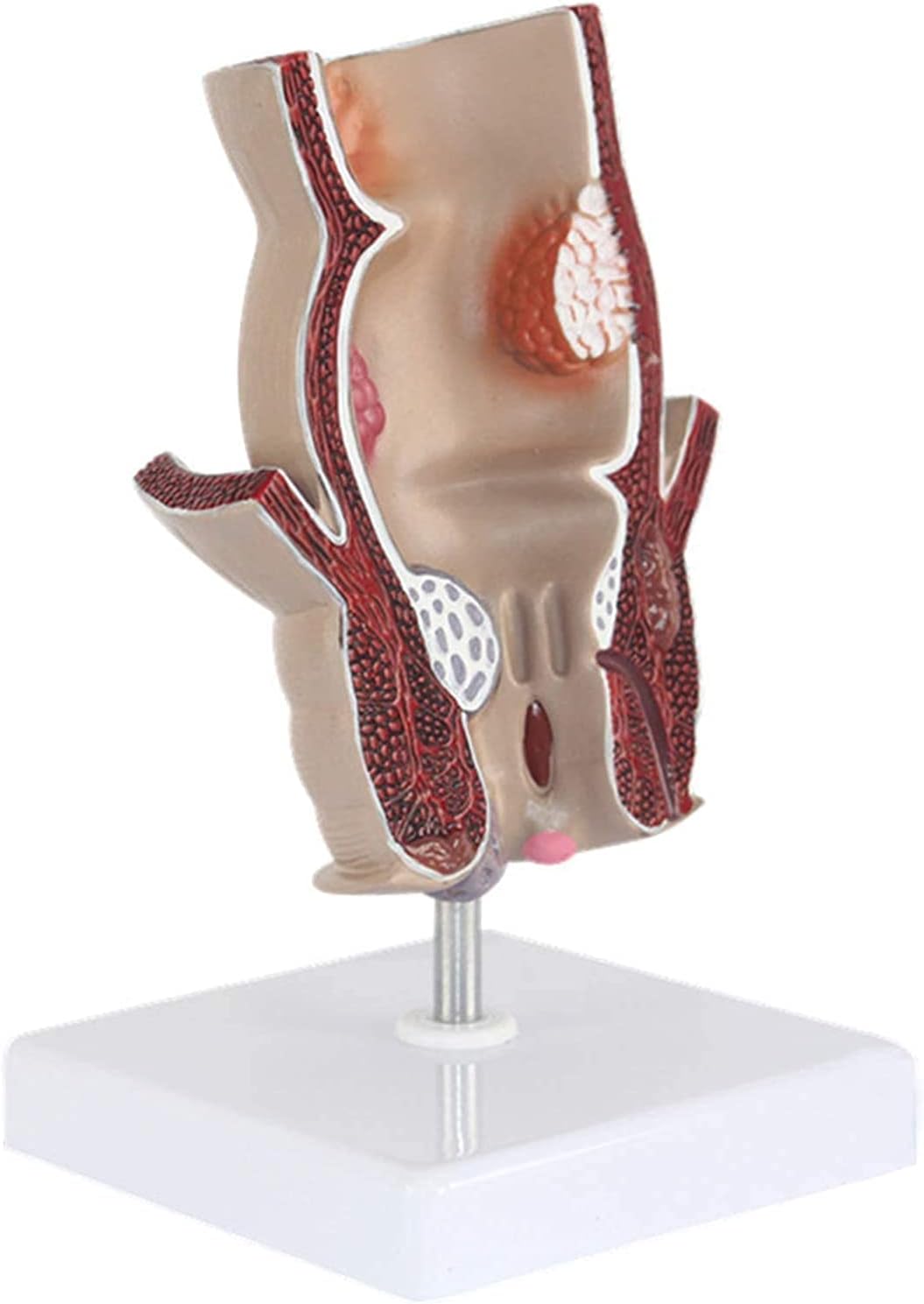UIGJIOG Modelo de patología Rectal Modelo de hemorroides, demostración de la Enfermedad de la tala de la protología, 5X Anal Anal y Anal Modelo Anal y anorecto Rectal 11 * 11 * 18,5 cm
