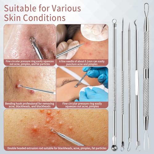 Blackhead Remover Tools, 8 Pack Pimple Popper Tool Kit, 4 Pack Tweezers Set, Quickly and Easily Removes Acne and Blackheads, Precision Eyebrow Tweezers for Facial Hair
