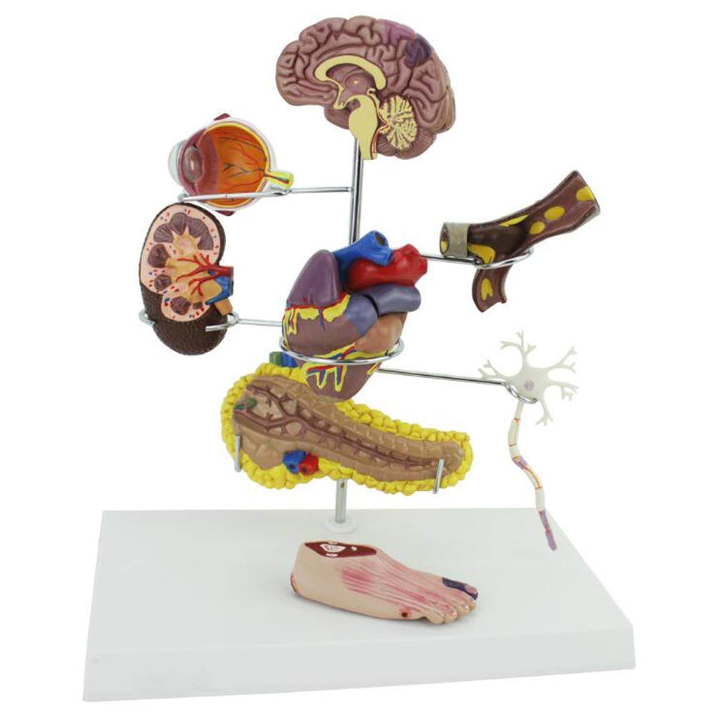 Buy ROSG ic Pathology Model-Media Teaching The Arteriopathy Display The ...