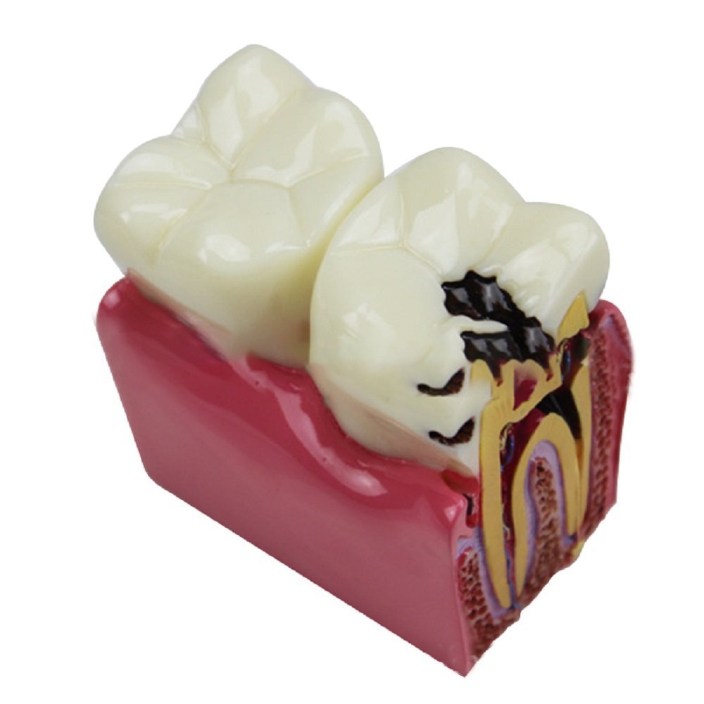 Buy Dental Model Cavity 6 Times Dental Caries Contrast Model Medical