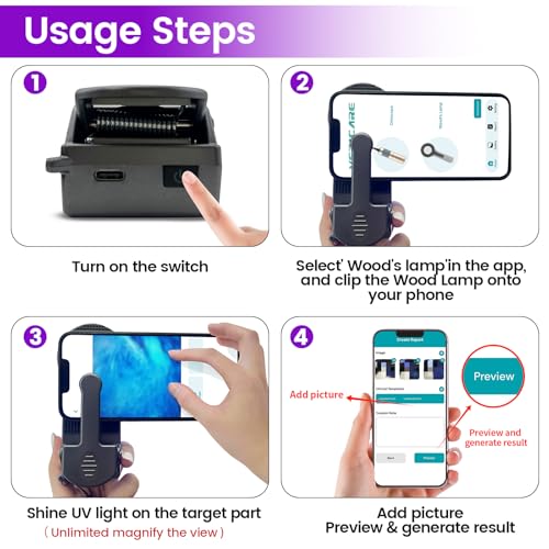 Image of Woods Lamp with Magnifying Glass, Rechargeable UV Flashlight Skin Analyzer, 365nm Ultraviolet Light LED Black Light for Pet Cat Urine Detection, Resin Curing, Cat Dog Ringworm