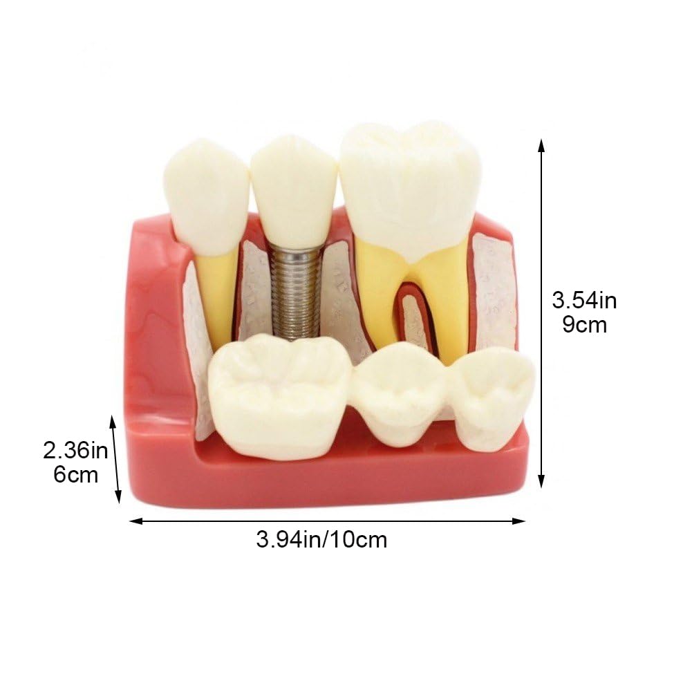 Modello di Impianto Dentale 4 Volte Modello di Denti Dimostrativo Ingrandito Modello di Denti Didattici Modello di Analisi Rimovibile Ponte della per Studente di Odontoiatria