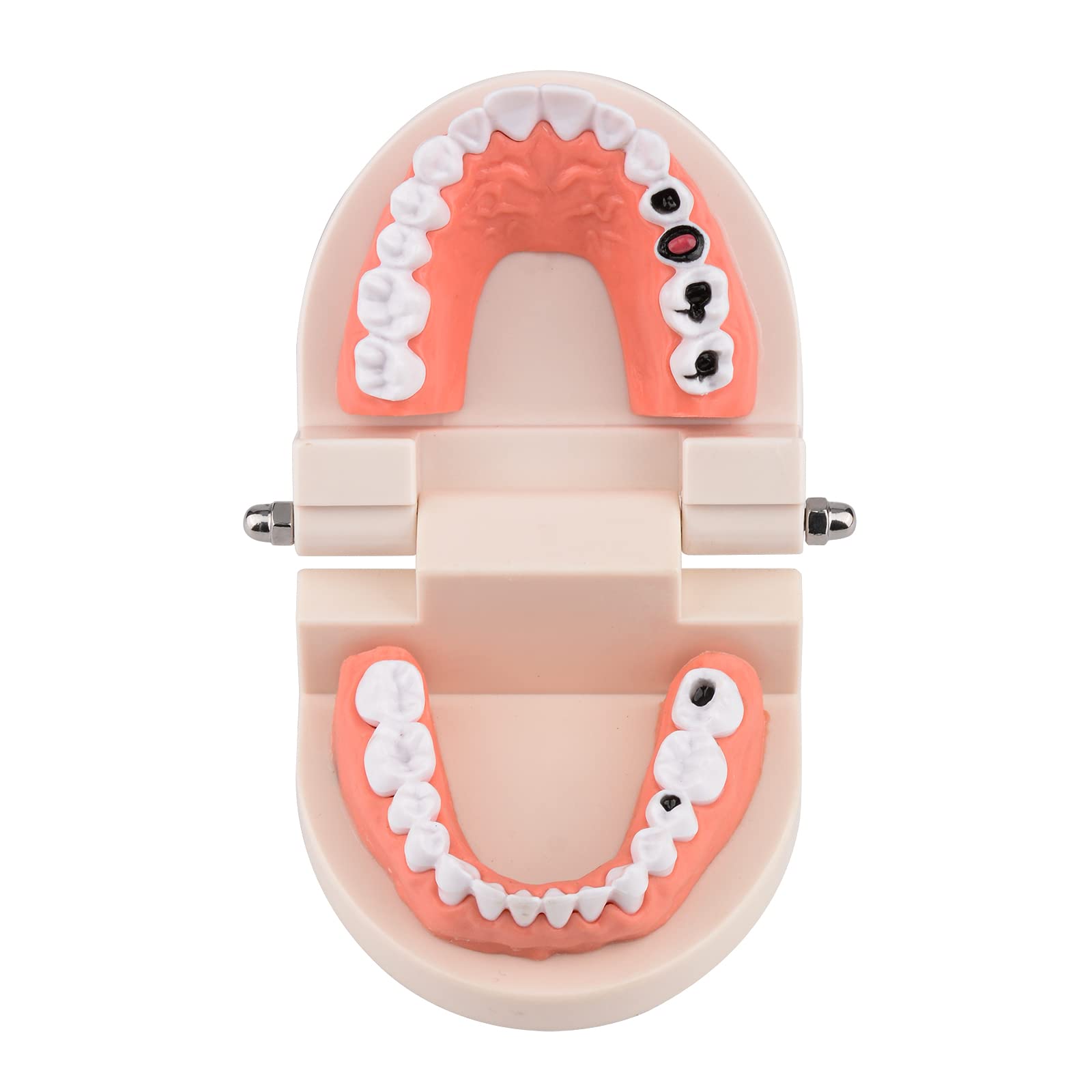 Ultrassist Dental Caries Study Model, 1:1 Life Size Fake Adult Dental Tooth Decay Model, Dental Hygiene Gifts for Teaching Kids Tooth Anatomy and Oral Care Education