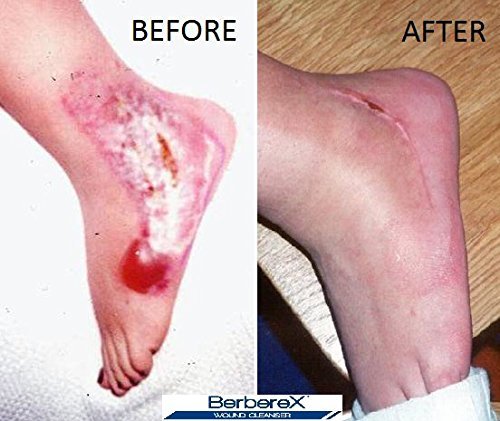 Berberex Antimicrobial Wound Cleanser For Cuts, Scrapes, Burns, Incisions, Piercing Aftercare, Wounds, Wound Care, First Aid Antiseptic Antibacterial Spray, Pressure Sore, Diabetic Ulcer - 4Oz #TOP2