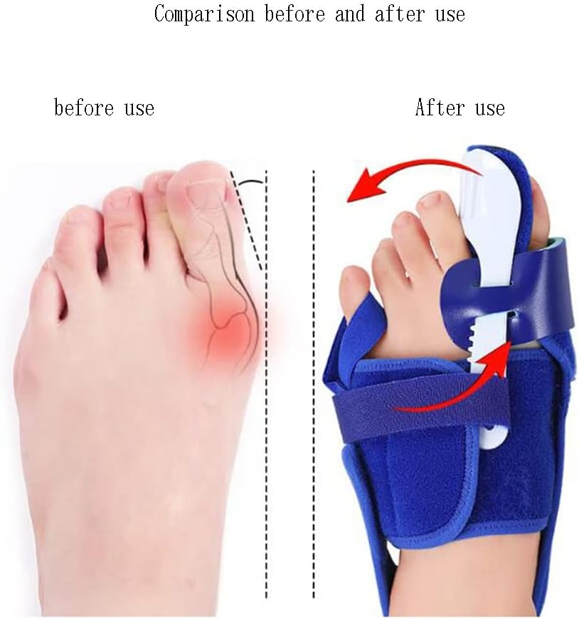 DEAVER Hallux Valgus Toe Corrector,Bunion Straightener,Men and Women Splint Reliefbunion Support Splitter Physiotherapy Painless Separator Pain Relief
